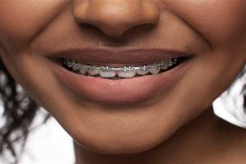 Top 5 Tips for Making Traditional Braces More Comfortable