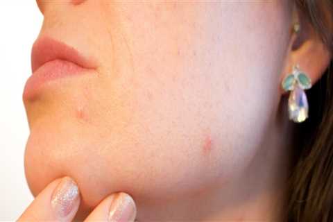 Post-Physical Therapy: Enhance Recovery with Acne Treatments
