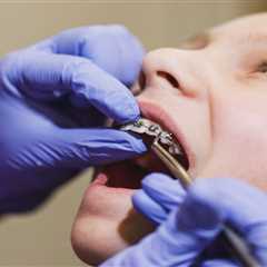 How Long Will I Wear Traditional Metal Braces in Tempe?