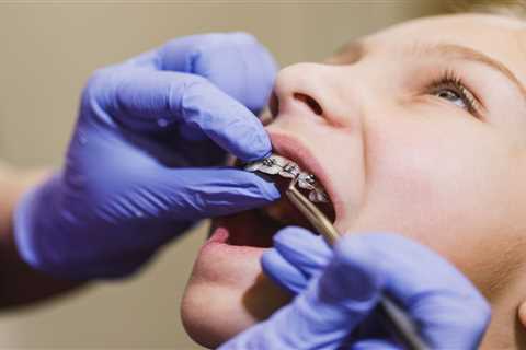 How Long Will I Wear Traditional Metal Braces in Tempe?