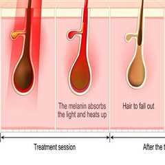 Understanding Hair Reduction Laser Treatment in Woodland Hills