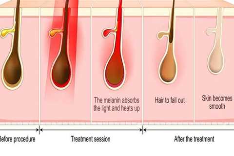 Understanding Hair Reduction Laser Treatment in Woodland Hills