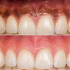 Laser Gum Whitening