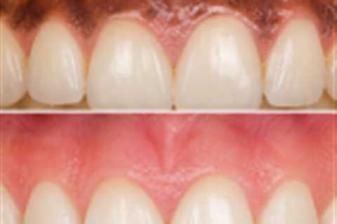 Laser Gum Whitening